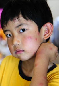 Child With Multiple Mosquito Bites